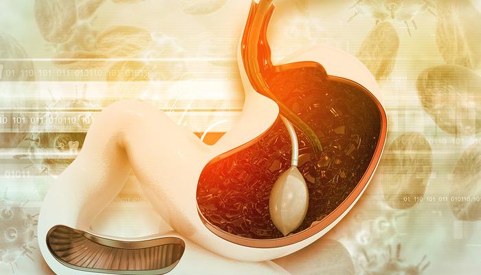 Fransa’da yasaklandı, Avrupa’da da yasaklandı! Türkiye’de mide balonu sistemi de tıkandı