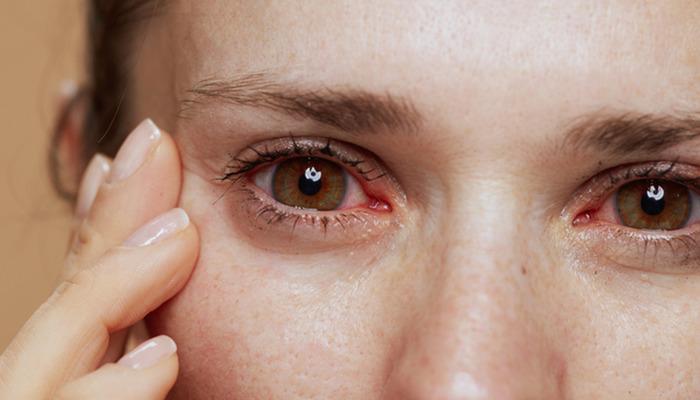 Zararsız görünüyor, ama hayatınızı etkiler! En yaygın bahar alerjilerinin sorunu: Gözlere alerjiye dikkat edin!